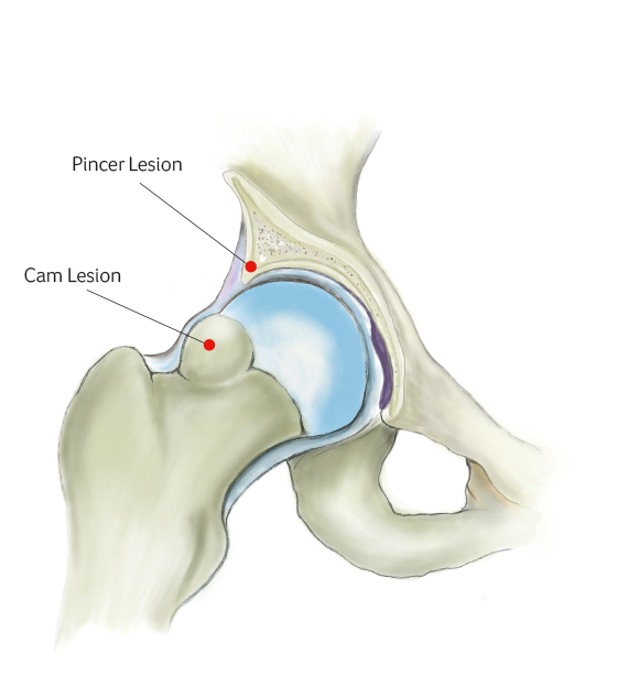 FEMOROACETABULAR IMPINGEMENT (FAI)