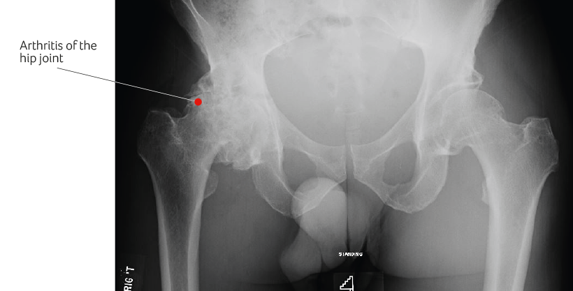 Common symptoms of hip osteoarthritis - UPMC Sports Surgery Clinic