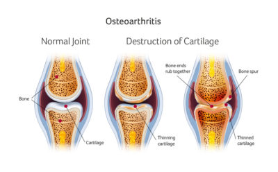 Osteoarthritis Knee Surgery Santry