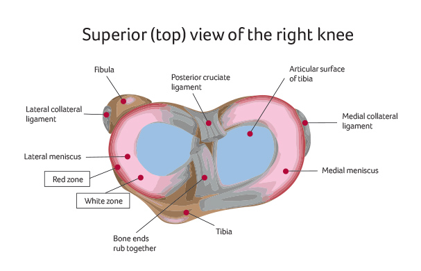 Meniscus in the knee Osteoarthritis Knee Replacement Santry