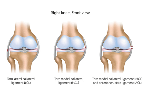 Medial Collateral Ligament (MCL) Medial Collateral Ligament (MCL) Knee Surgery Santry