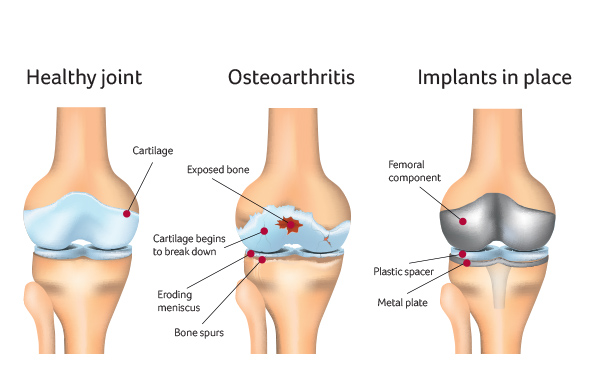 Knee Replacement Surgery Osteoarthritis in knee