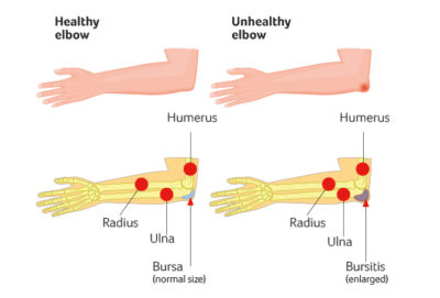 Olecranon Bursiitis Santry