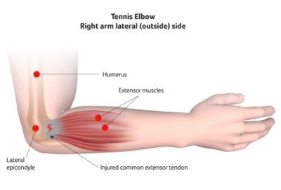 Tennis Elbow Santry