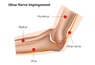 Ulnar Nerve UPMC Sports Surgery Clinic