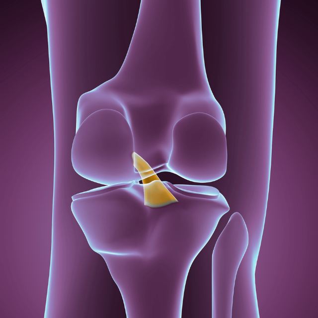 ACL Injuries in Teenagers